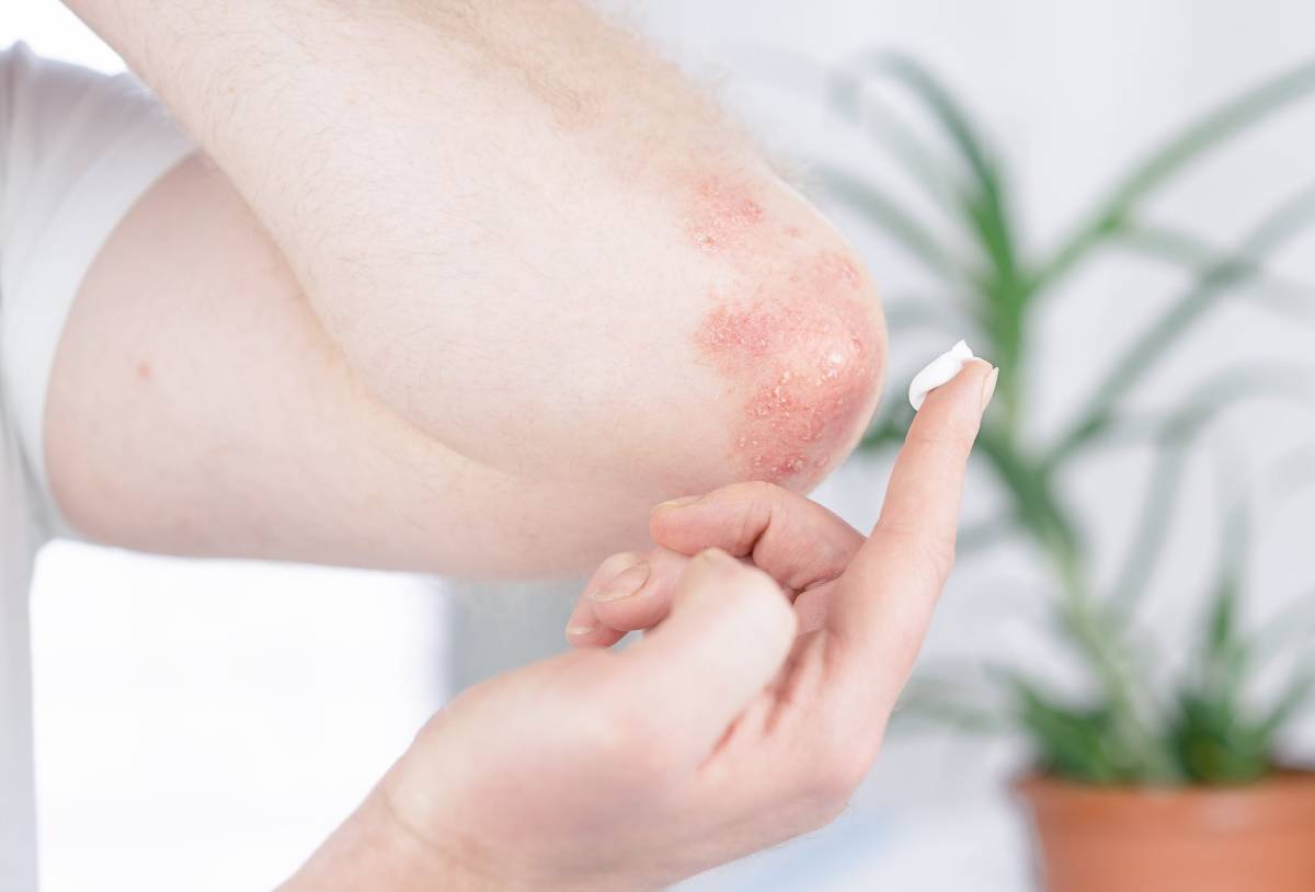 un uomo con psoriasi si spalma della crema sul gomito
