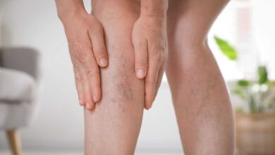 donna con trombosi mentre si tocca con entrambe le mani la gamba con vene in evidenza